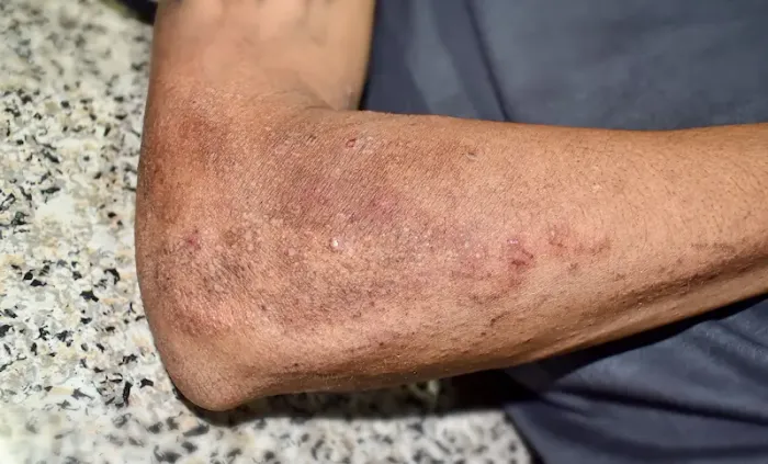 Pellagra Understanding Symptoms and Treatment